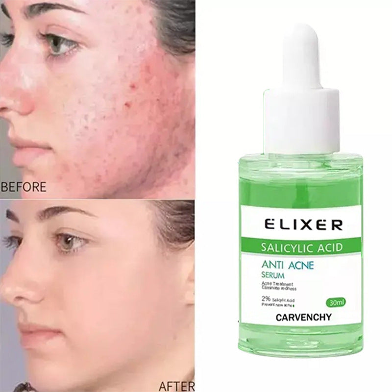 Far-A-We Anti-Acne Hydraterende gezichtsserum voor huidverzorging, zichtbaar in een glazen fles met pipet.